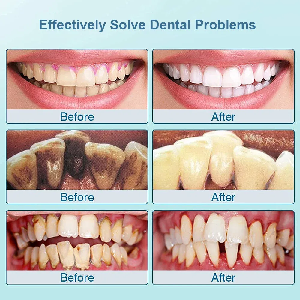 Technical specifications and comparison of teeth whitening methods